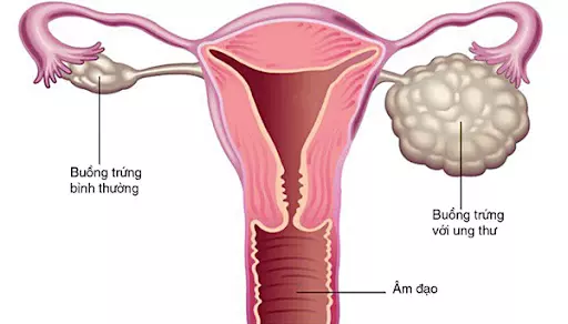 Ung thư buồng trứng là biến chứng nguy hiểm của u nang bì buồng trứng
